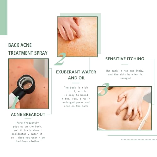 Back Acne Treatment Spray 120ml | Fade Scars, Deep Cleanse, Smooth Skin