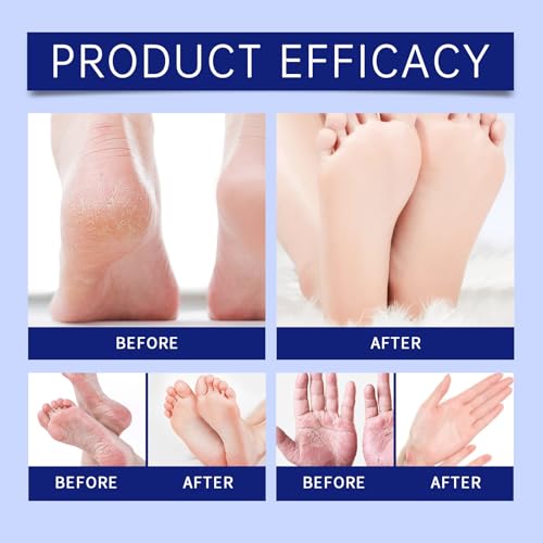 40% Urea Foot Cream - Intense Moisturizer for Cracked Heels & Overnight Repair