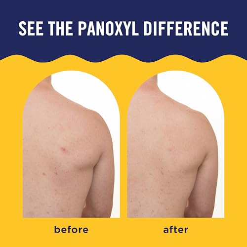 PanOxyl Acne Banishing Body Spray with 2% Salicylic Acid - 6 Oz | Pimple Treatment Spray for Stubborn Breakouts