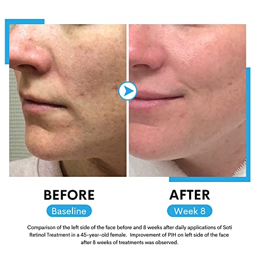 Retinol Face Serum - Reduces Wrinkles, Age Spots, Post-Acne Marks with Hyaluronic Acid & Niacinamide (30ml)
