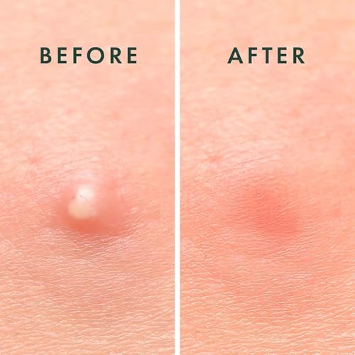 ALMEKAQUZ 108Pcs Hydrocolloid Acne Patches with Tea Tree Oil - Vegan & Cruelty-Free Pimple Treatment