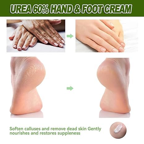ALMEKAQUZ 60% Urea Foot & Hand Cream – Maximum Strength with 2% Salicylic Acid for Dry, Cracked Skin