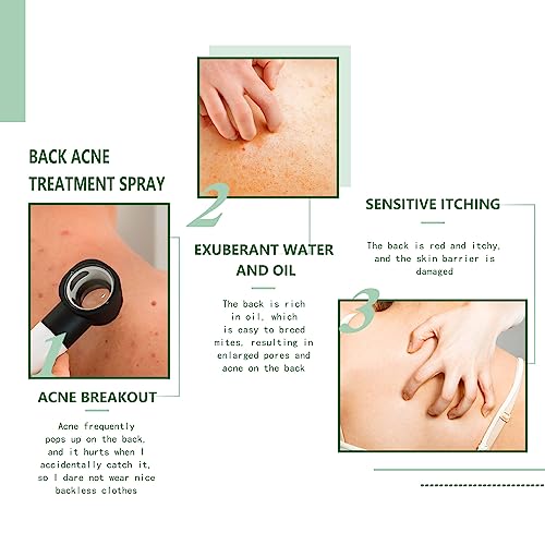 Body & Back Acne Spray with Salicylic Acid & Herbal Formula