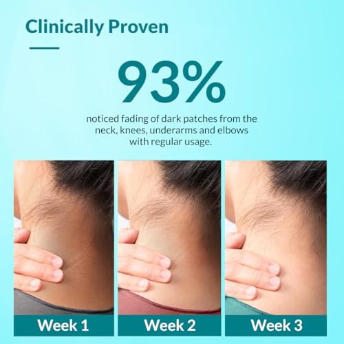Fixderma Nigrifix Cream for Acanthosis Nigricans - Lactic Acid & Retinol Cream for Dark Body Parts - 50g