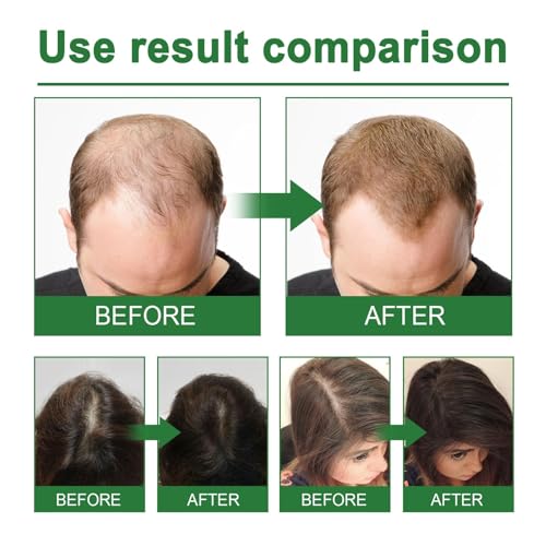 NALACAL Hair Growth Serum for Women - Natural Hair Loss Treatment & Repair