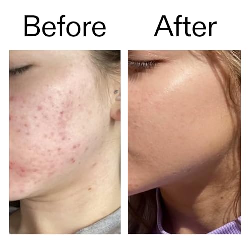 The INKEY List Beta Hydroxy Acid (BHA) Serum - Face Exfoliant for Pores & Blackheads, 1.01 fl oz