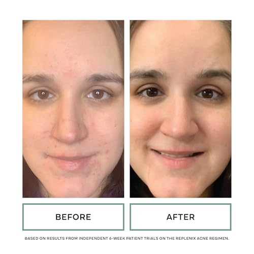 Replenix Benzoyl Peroxide 10% Acne Wash with Aloe Vera - 6.7 Fl Oz