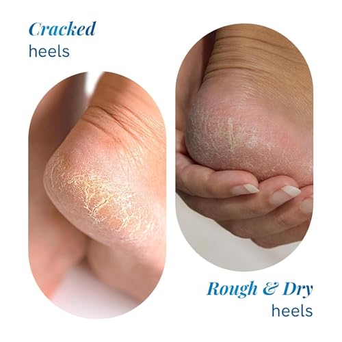 Be Bodywise 20% Urea Foot Cream Roll On 75ml - For Dry & Cracked Heels with Lactic Acid, Vitamin E & Olive Oil - Moisturizes & Repairs