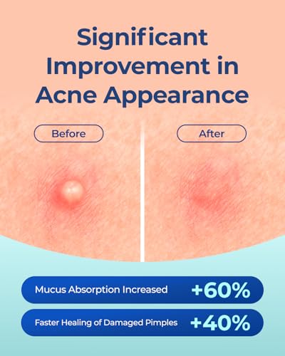 POINTMASS Ultra-Thin Acne Patches with Tea Tree Oil - 44 Count Hydrocolloid Zit Stickers