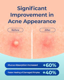POINTMASS Ultra-Thin Acne Patches with Tea Tree Oil - 44 Count Hydrocolloid Zit Stickers