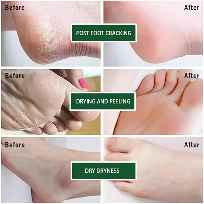 YelaJoy Urea 40% Plus Foot Cream - 2Pcs, 40g Each
