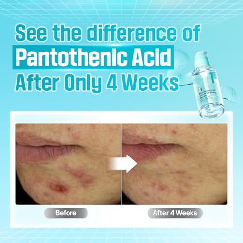 numbuzin No.1 Pantothenic B5 Active Soothing Serum – Hydrating & Calming Formula for Dry, Combination Skin
