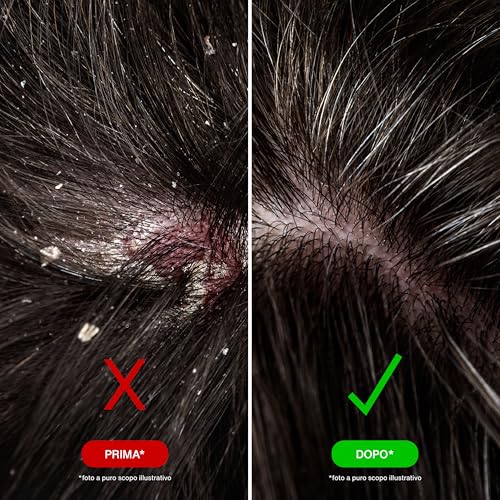 Shampoo for Seborrheic Dermatitis - Aloe Vera & Zinc Formula, Fragrance-Free, SLS & SLES Free - 200 ml