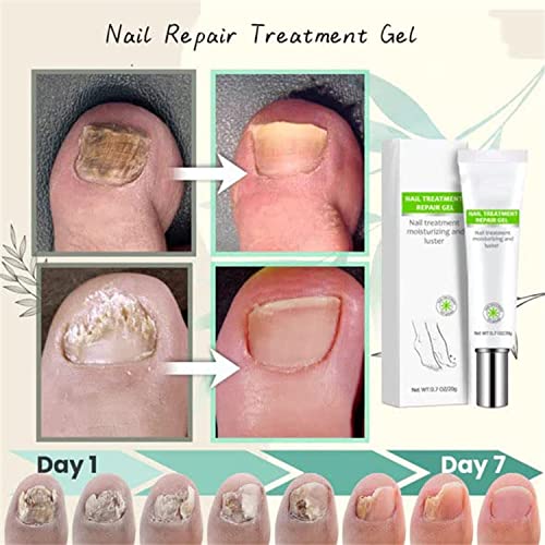 Flyles Nail Repair Gel for Damaged Nails, 2 Pack