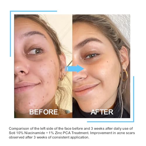 Niacinamide 10% + Zinc 1% Face Serum with B5 & Hyaluronic Acid – Pore Reducer & Acne Marks