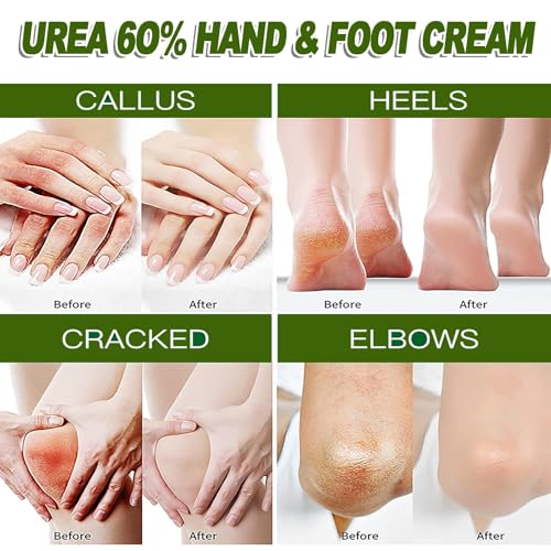 Hydrating Urea Foot & Hand Cream with 60% Urea & 2% Salicylic Acid