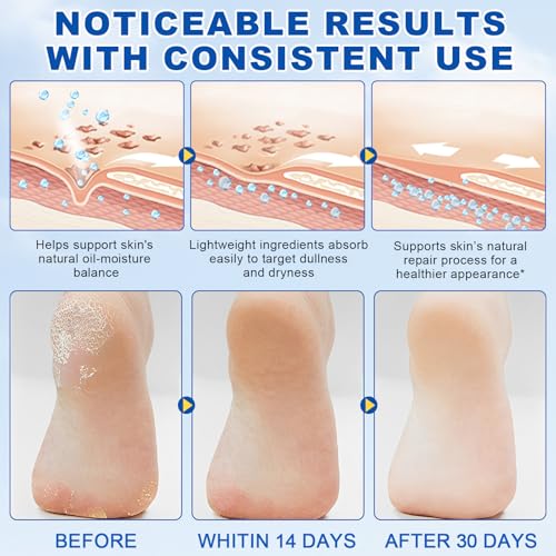 60% Urea Cream Stick with 2% Salicylic Acid - Maximum Strength Callus Remover 1.4oz