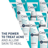 CeraVe Acne Foaming Cream Cleanser, 5 oz, Fragrance-Free & Non-Comedogenic