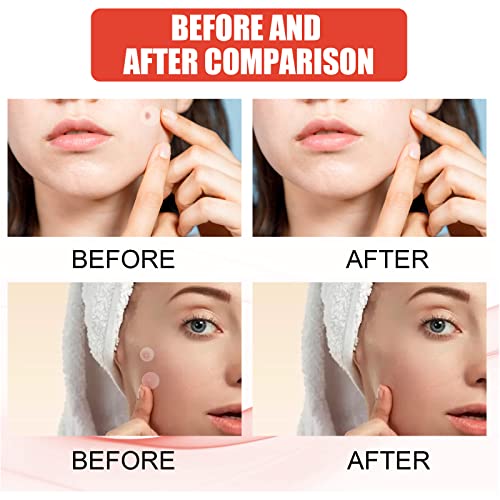 JDLYEVER Hydrocolloid Acne Patch - Invisible Makeup Closed Acne Patch, Waterproof & Breathable, 144 Patches
