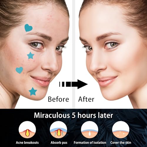 POSICHE Hydrocolloid Acne Patches 216 Pieces - Clean, Clear & Conceal Blemishes