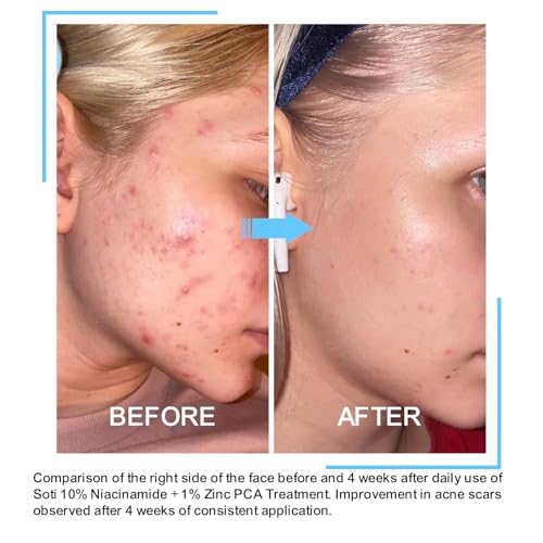 Niacinamide 10% + Zinc 1% Face Serum with B5 & Hyaluronic Acid – Pore Reducer & Acne Marks