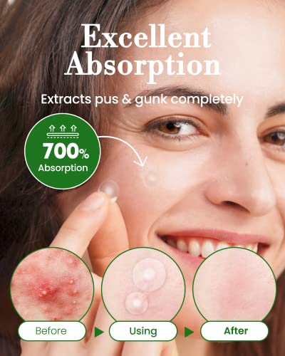 Troubless Invisible Pimple Patch Signature - Hydrocolloid Spot Treatment for Nighttime Use, 96 Patches