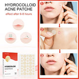 JDLYEVER Hydrocolloid Acne Patch - Invisible Makeup Closed Acne Patch, Waterproof & Breathable, 144 Patches