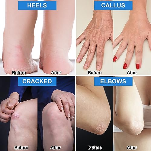 Urea Cream Plus Salicylic Acid - Foot & Hand Repair Treatment 7.06oz