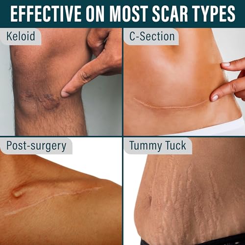 NUVADERMIS Silicone Scar Tape for Surgical Scars, 120x1.5 Roll