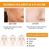 Hydrocolloid Face Mask - Large Pimple Patches for Zit Breakouts, Vegan & Cruelty-Free