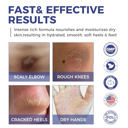 OUKEYA Urea Cream 42% + Salicylic Acid 2% - Intensive Repair Foot & Hand Cream for Cracked Skin - Relief for Dry Feet, Heels & Elbows