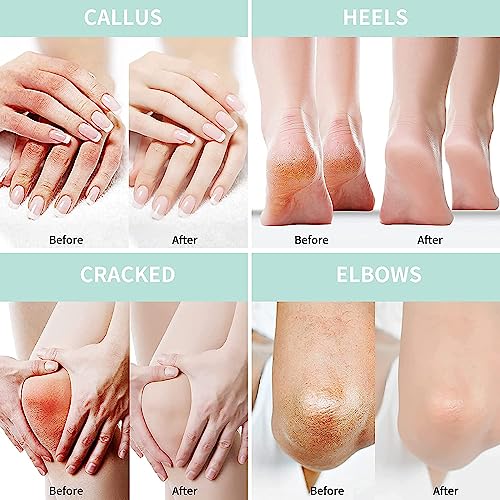Urea Cream 40% for Feet with 2% Salicylic Acid - Maximum Strength Foot & Hand Cream with Hyaluronic Acid, Tea Tree & Aloe Vera - 250g