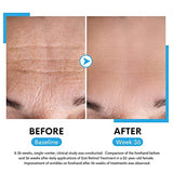 Retinol Face Serum - Reduces Wrinkles, Age Spots, Post-Acne Marks with Hyaluronic Acid & Niacinamide (30ml)