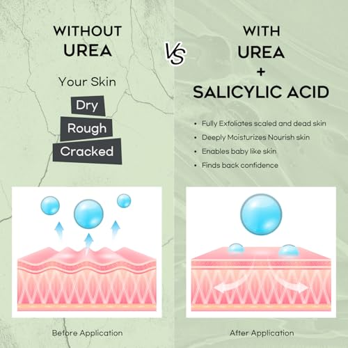 Urea Cream 42% Foot Cream with Salicylic Acid - Callus Remover for Feet, Knees & Elbows - Intensive Moisturizer & Exfoliator - 4 Oz