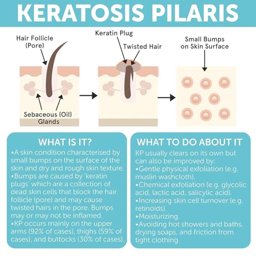 Keratosis Pilaris Body Lotion with Exfoliating AHA BHA & Glycolic Acid for Strawberry Legs Skin Care