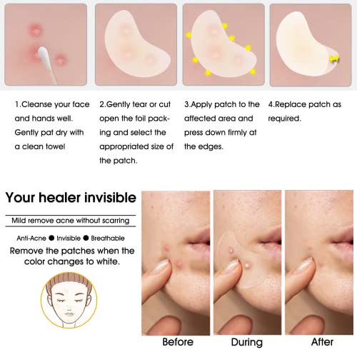 Hydrocolloid Acne Patch (20 Patches) - Large Spot Control Cover for Body, Cheek, Forehead, and Chin