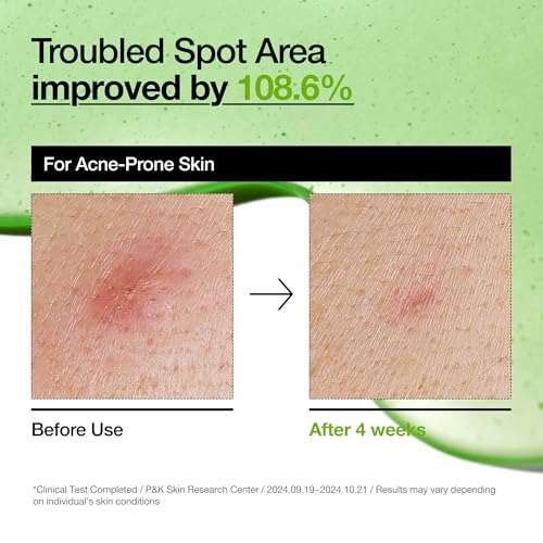 ANUA Azelaic Acid 10% Hyaluron Redness Soothing Serum – 30ml