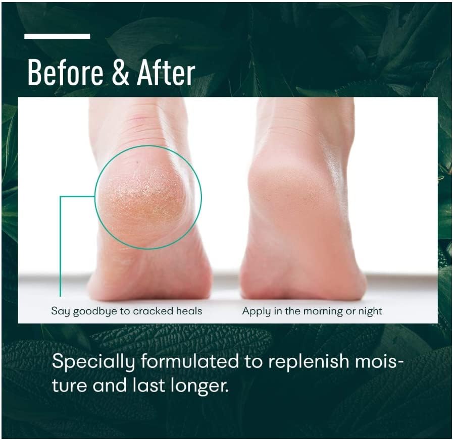 Urea 42% Foot Cream with Salicylic Acid - Cracked Heel Repair 5.29oz